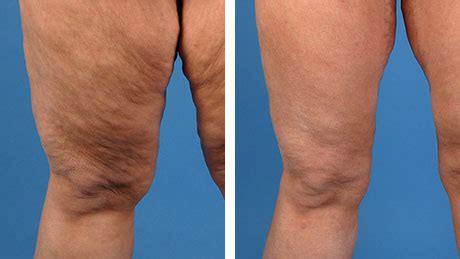 Thigh Lift (Thighplasty): Types, Surgery, Recovery & Scars